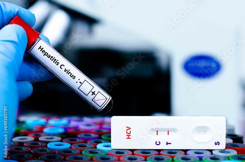 The patient positive tested for hepatitis C virus by rapid diagnostic test. photo
