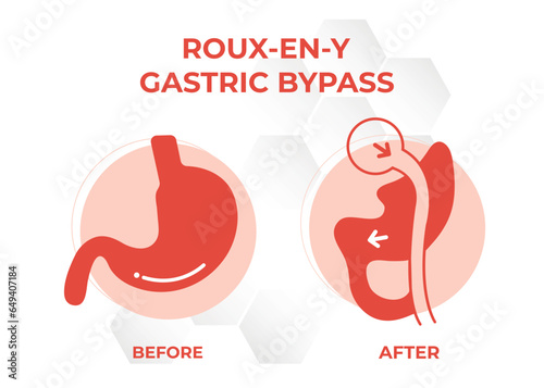  Gastric Bypass RNY Weight Loss Surgery vector illustration icon Roux-en-Y