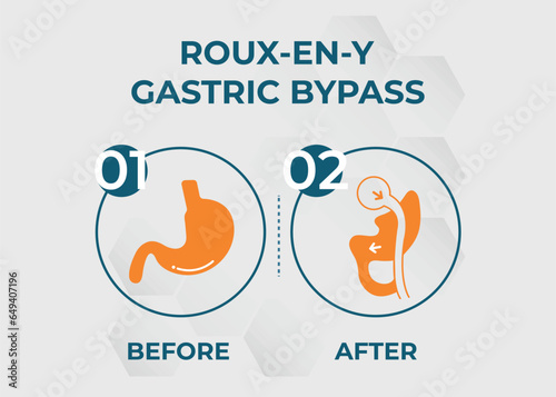  Gastric Bypass RNY Weight Loss Surgery vector illustration icon Roux-en-Y
