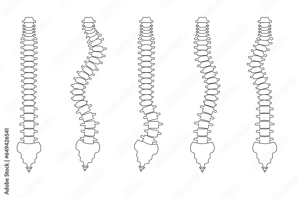 側湾症の背骨のシンプルなイラスト Stock Illustration | Adobe Stock