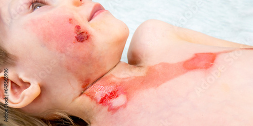 medical procedure dressing a boy with a first-degree burn from boiling water on his face, neck and chest