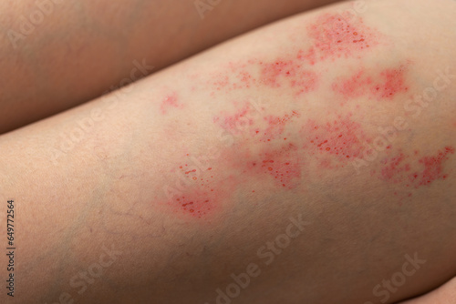 Painful shingles in woman