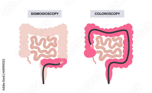 Colonoscopy and sigmoidoscopy