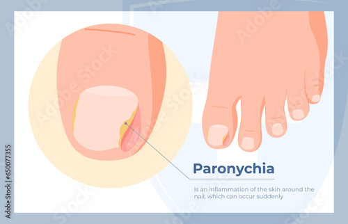 Nail rot, ingrown toenails, toe disease. Treatment and care of problem nails. Vector illustration photo