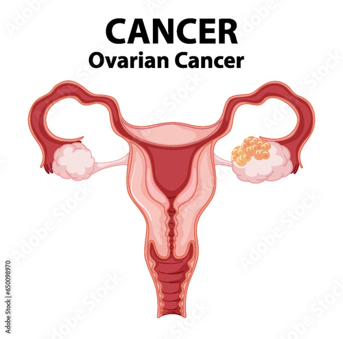 Comparing Normal and Cancerous Ovaries: A Medical Infographic