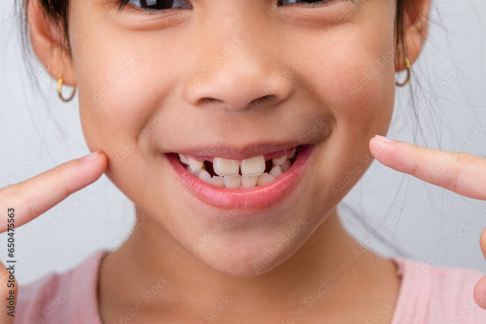 Close-up of cute young girl smiling wide, showing empty space with growing first front teeth. Little girl with big smile and missing milk teeth. Dental hygiene concept Close-up of cute young girl smiling wide, showing empty space with growing first front teeth. Little girl with big smile and missing milk teeth. Dental hygiene concept