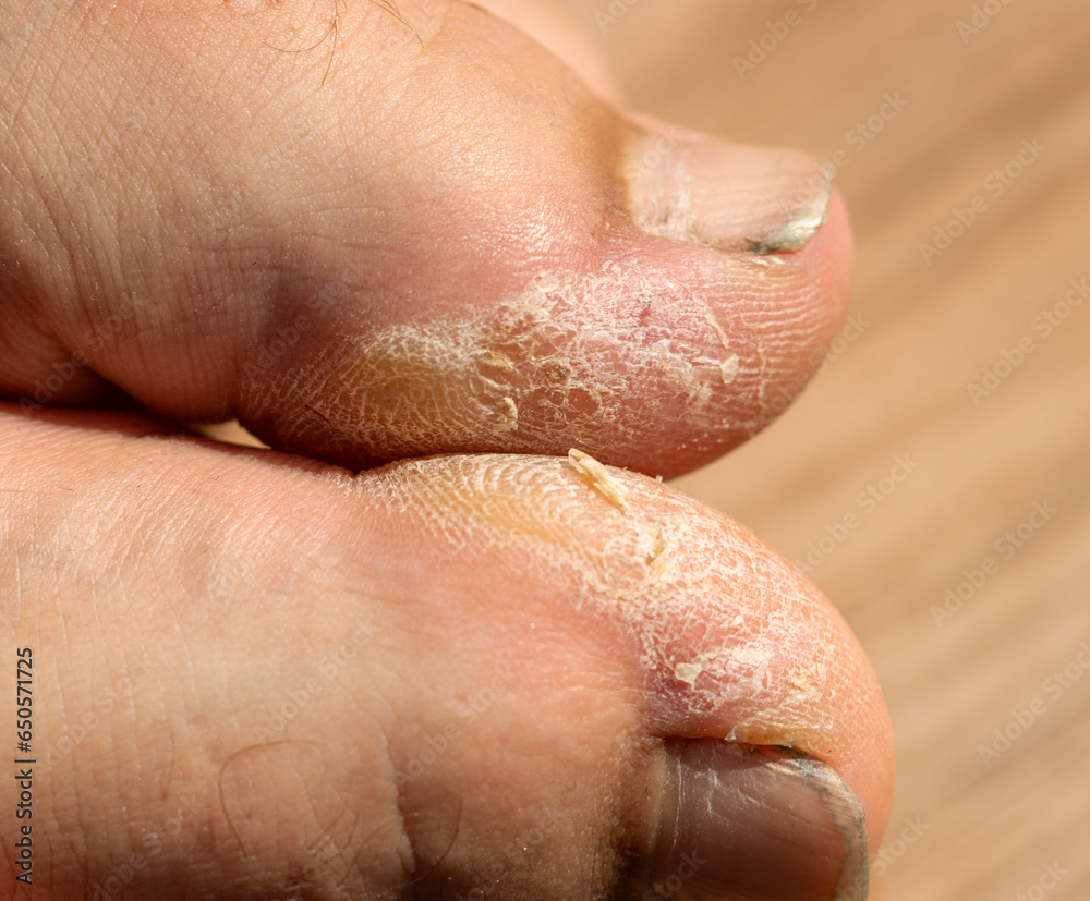 Fototapeta premium dry rough skin on toes as background.