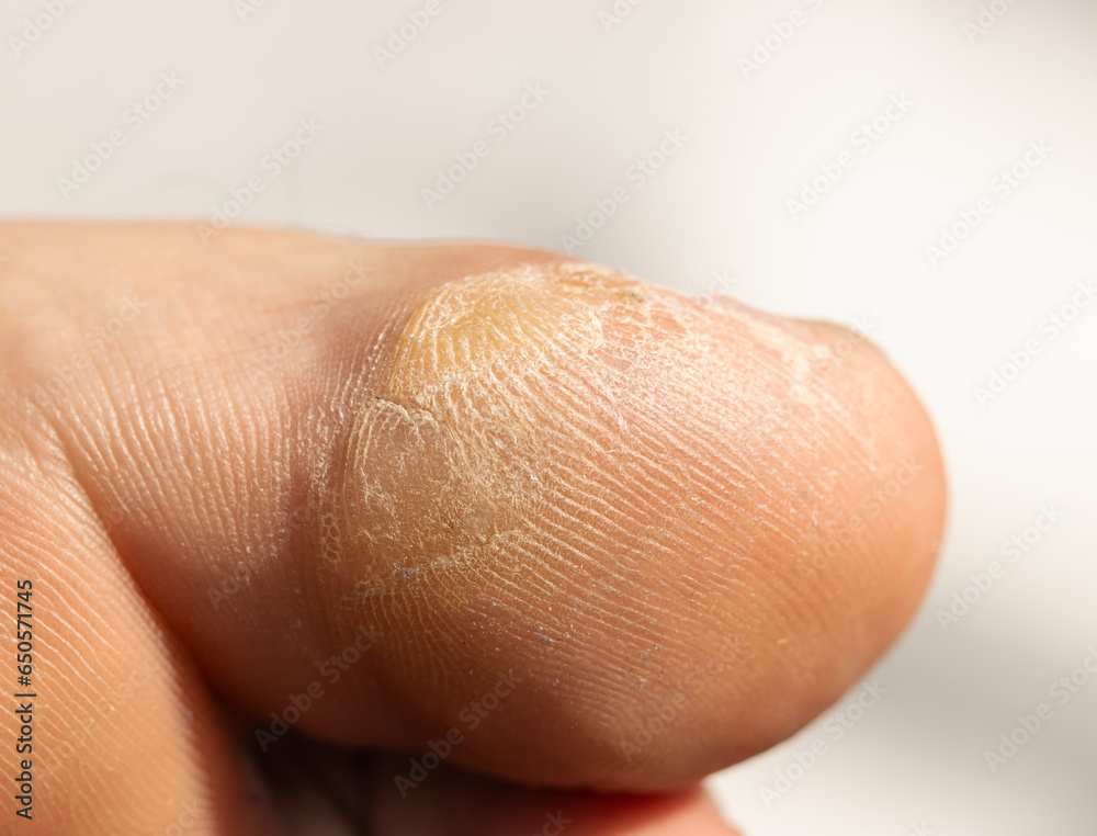 dry rough skin on toes as background. dry rough skin on toes as background.