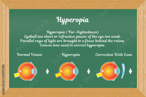 Hyperopia in eye disorders vector illustration
