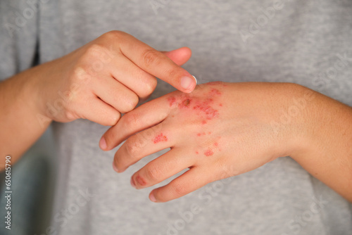 Patient hands applying ointment cream on eczema. Dermatitis, atopic skin. photo