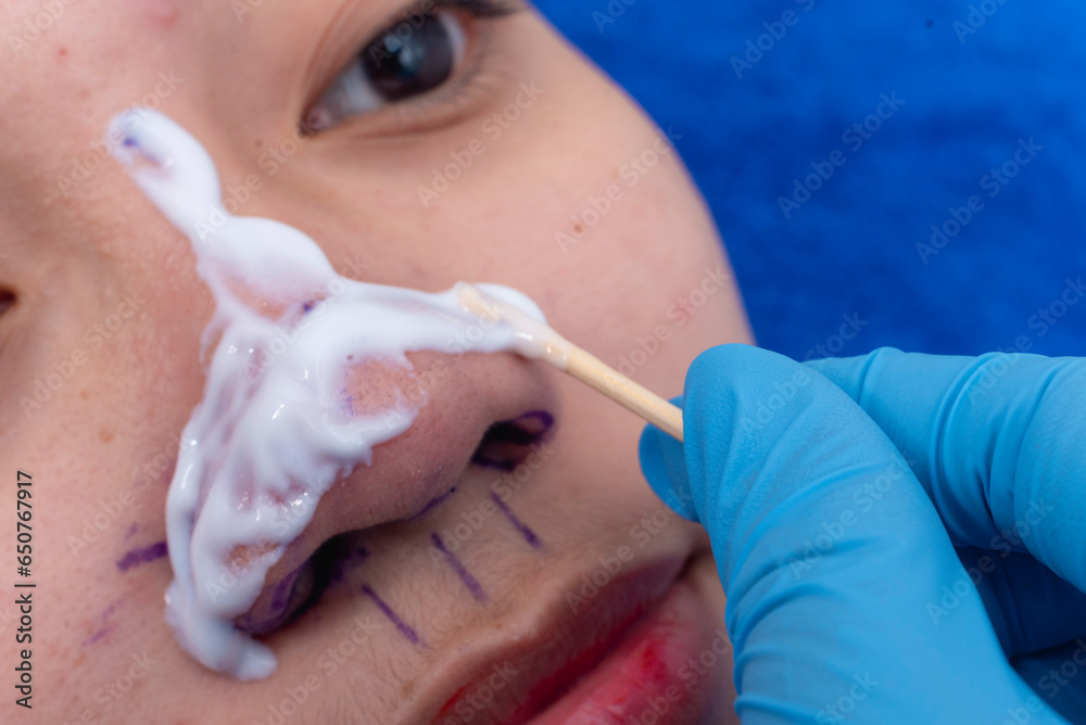 Applying topical anesthesia via a cotton swab to the nose to numb the