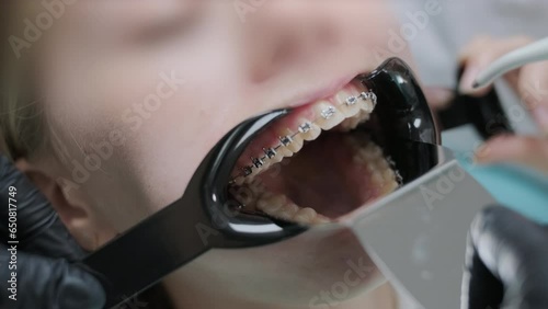 Close up of dentist hand using dental forceps while putting orthodontic braces on female patient teeth. Woman having dental procedure in clinic. Concept of dentistry and orthodontic treatment.