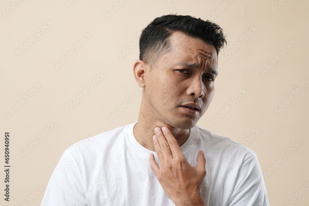 A Photo of Acne and pores on the face of a young Asian man. Improper therapy has led to a form of inflammation face and isolated on a cream background. A Photo of Acne and pores on the face of a young Asian man. Improper therapy has led to a form of inflammation face and isolated on a cream background.