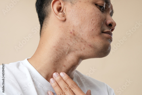 Photo of young Asian man with problem skin wearing white t-shirt isolated on beige background.