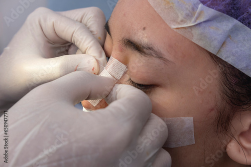 A cosmetic surgeon applies nose bridge bandage and mustache dressing after nasal surgery, septoplasty or rhinoplasty.