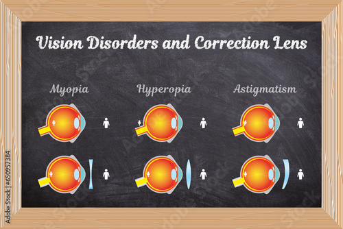 Konstfotografi Eye disorders and correction lens vector illustration