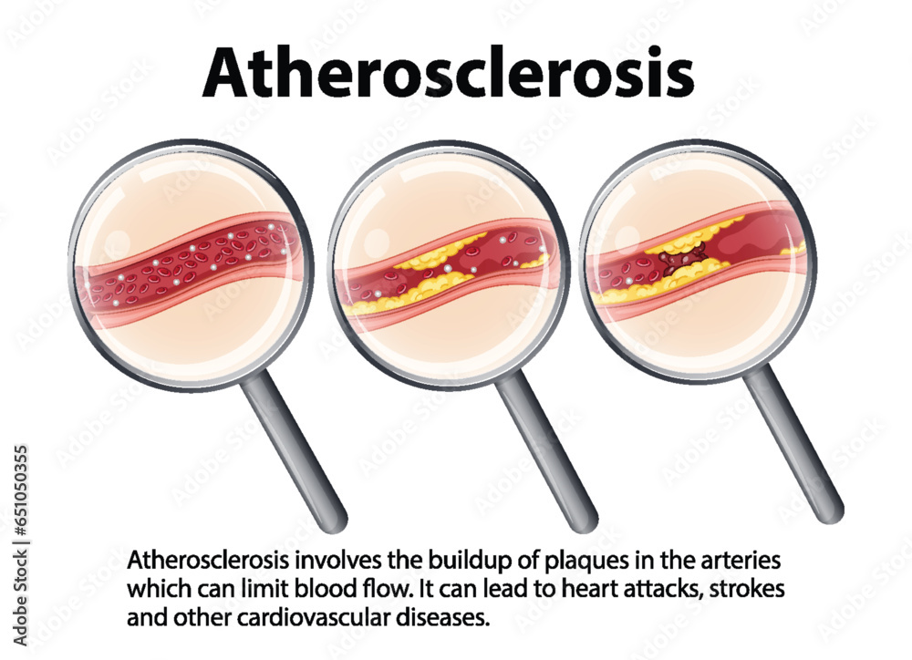 Science Education Human Anatomy And Atherosclerosis Development Stock