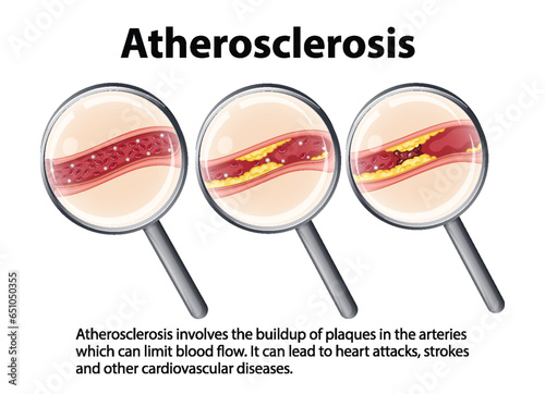Science Education: Human Anatomy and Atherosclerosis Development