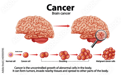 Medical Anatomy Infographic: Brain Cancer and Abnormal Cell Growth