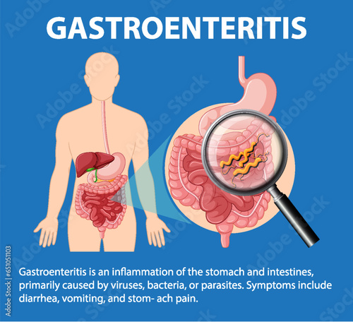 Gastroenteritis: Infection, Inflammation, and Digestive System Symptoms photo