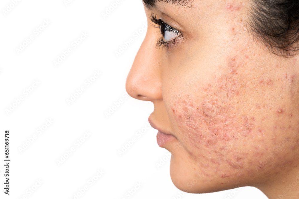 Acne on the young girl's face. Acne in teenage girl Acne on the young girl's face. Acne in teenage girl