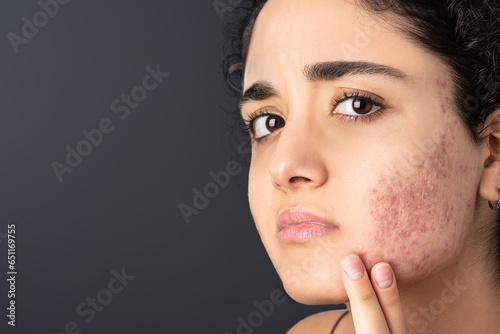 Acne on the young girl's face. Acne in teenage girl