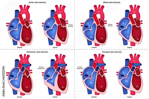 Heart valve disease vector. Cross section of human heart. Aortic stenosis, Mitral stenosis, Pulmonary stenosis and Tricuspid stenosis.