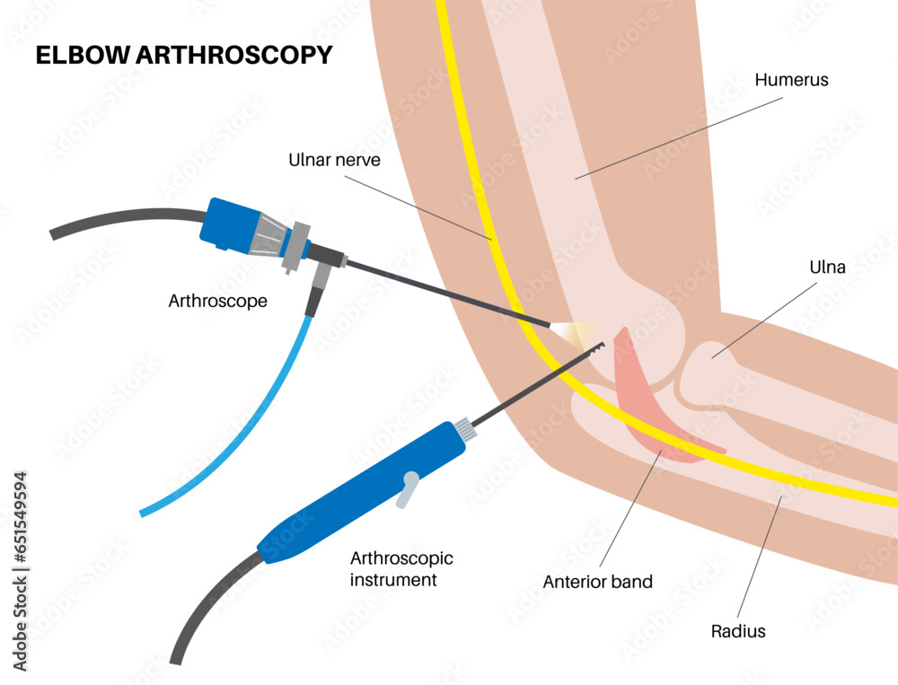 Obraz premium Elbow arthroscopy surgery
