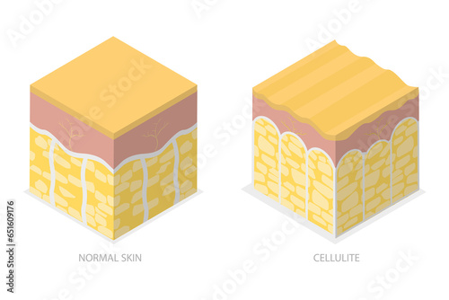 3D Isometric Flat  Conceptual Illustration of Cellulite Skin, Womans Beauty and Skicare photo