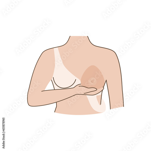 Woman after mastectomy. A girl without breasts tries on a breast prosthesis. Breast cancer. Vector illustration.