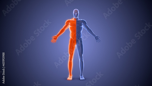 Tableau sur toile Hemiplegia paralysis condition medical concept