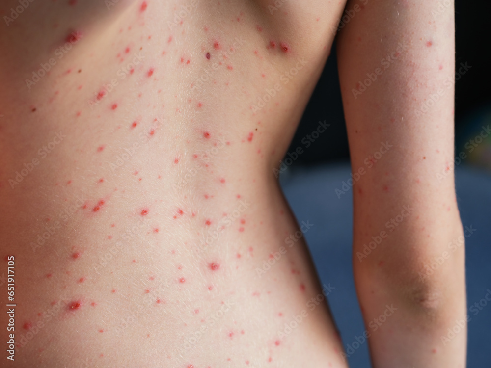 Persons back with chickenpox (varicella) blisters on his skin. - obrazy, fototapety, plakaty 