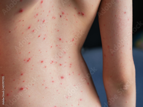 Persons back with chickenpox (varicella) blisters on his skin.