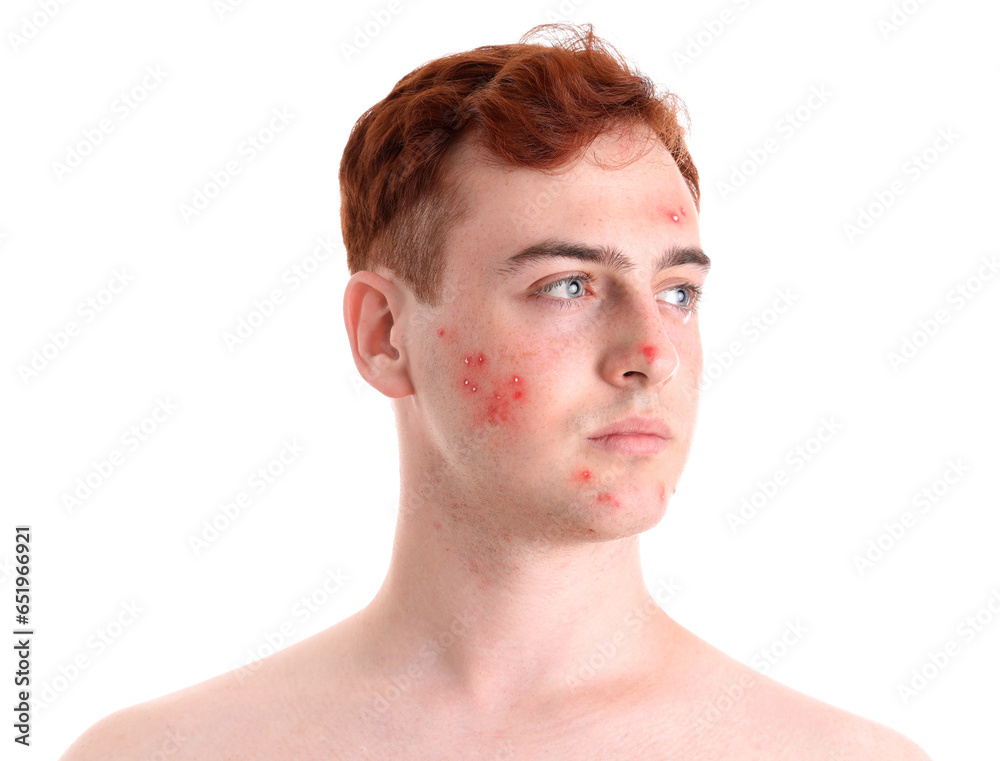 Obraz premium Teenage boy with acne on white background