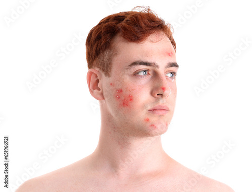 Teenage boy with acne on wh...