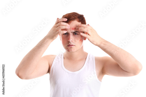 Teenage boy with acne squis...