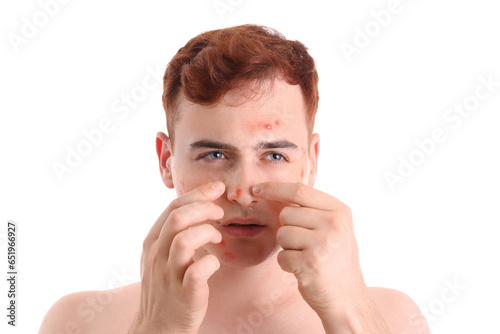 Teenage boy with acne squis...