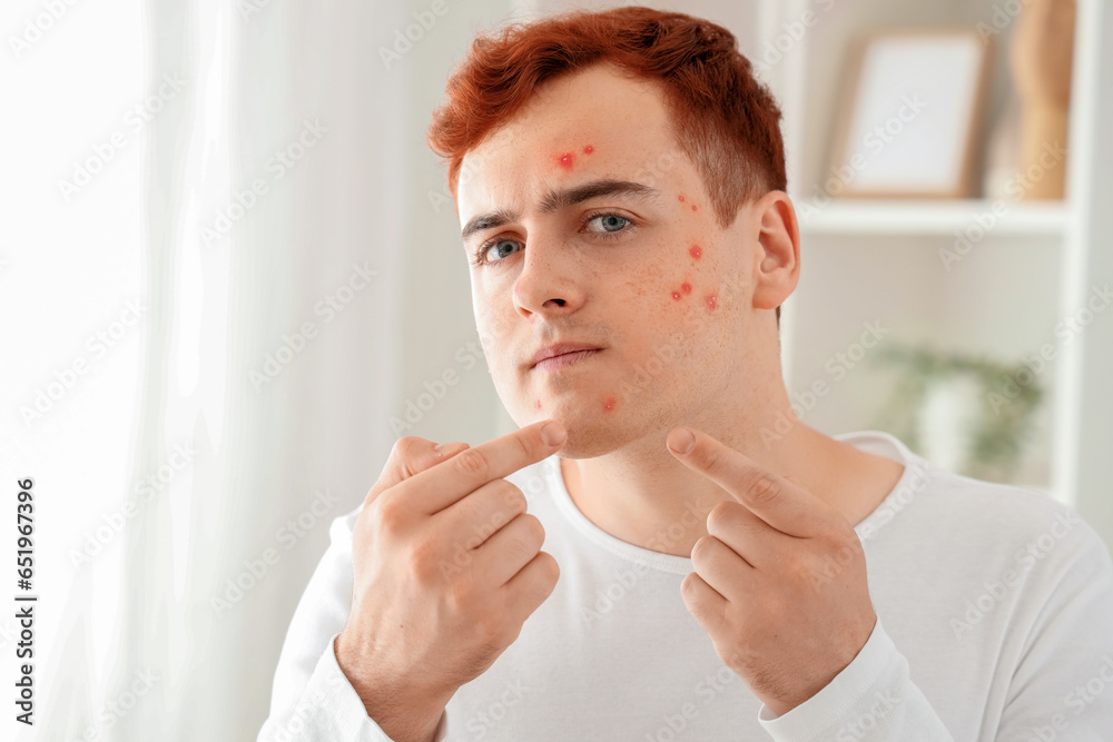 Teenage boy with acne squishing pimples in bathroom Teenage boy with acne squishing pimples in bathroom