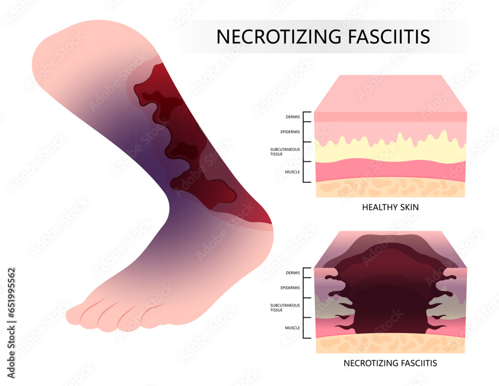 Diabetic foot and Bacteria infection on the skin cancer with