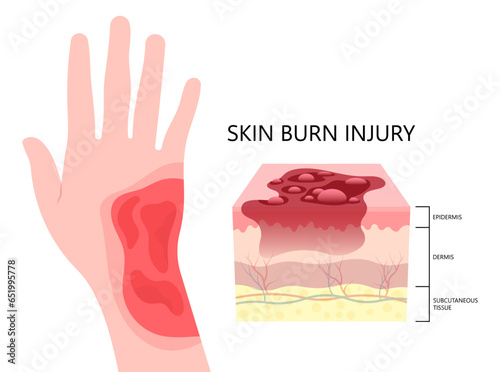 Hand with scald or skin burn injury the degree of epidermis tissue layer exposure to heat and flames