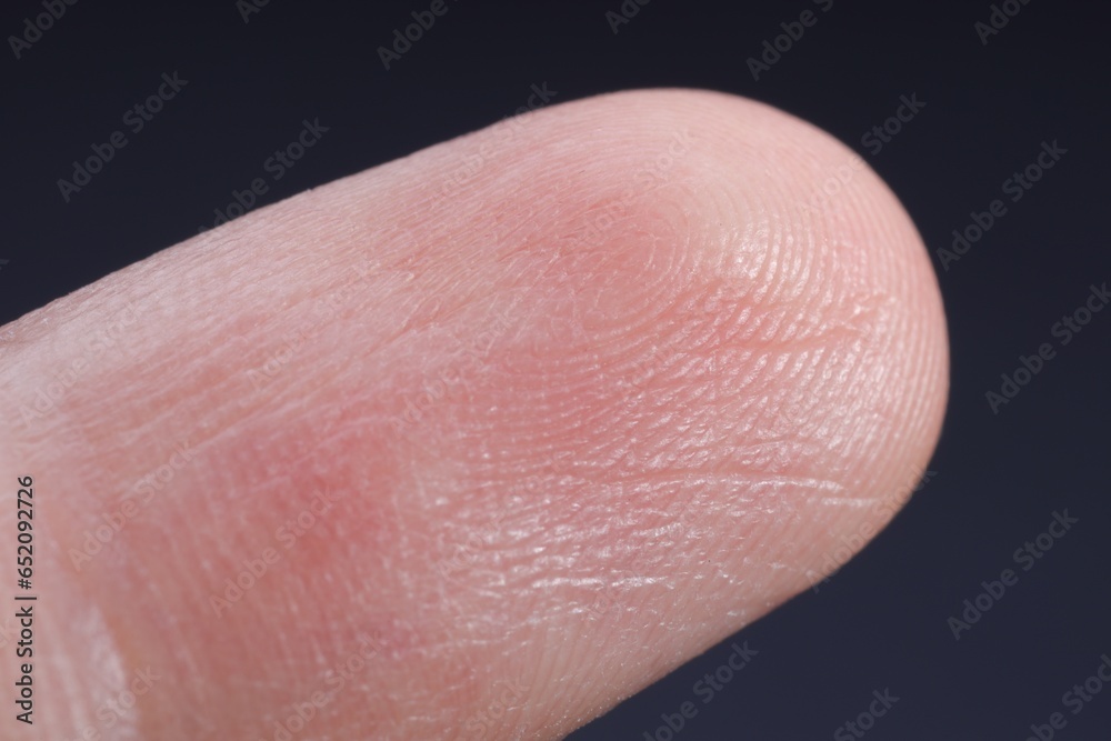 Finger with friction ridges on dark background, macro view Finger with friction ridges on dark background, macro view