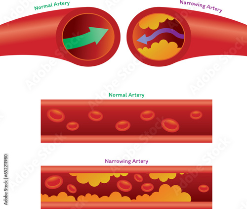 Normal Artery and Narrow Artery because Cholesterol Fat Cell