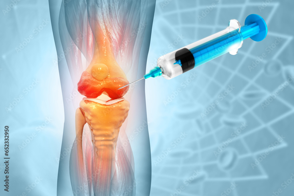 Anatomy Human Knee Joint Treatment, Osteoarthritis Injection, Drug