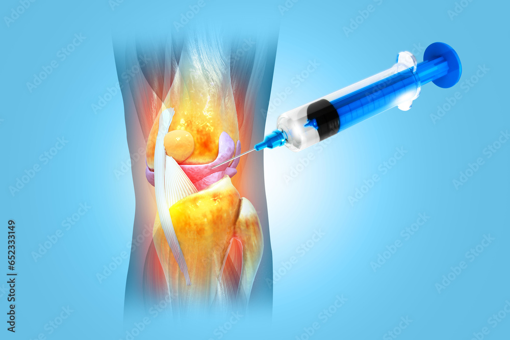 Anatomy Human Knee Joint Treatment, Osteoarthritis Injection, Drug