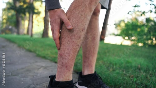 Close-up of a man leg with dermatitis scratching the blisters. Redness, itching skin, rash. 
