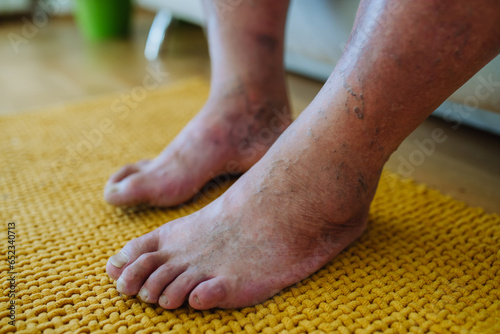 Cuadro en lienzo A close-up shot of man's feet with diabetic foot complications.