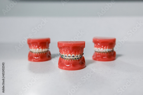 Three teeth models with braces on white table