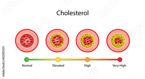 Atherosclerosis, normal artery versus narrowed artery blocked with cholesterol plaque. Blood vessel blocked with a clot. High cholesterol level as atherosclerotic risk. ldl and hdl. Vector design photo
