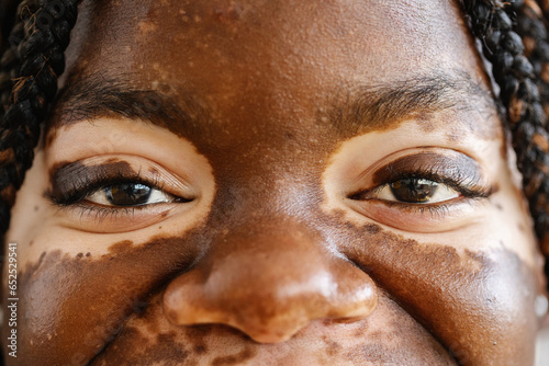 Close-up view shot of young adult african woman eyes with vitiligo skin. Diversity and people concept photo