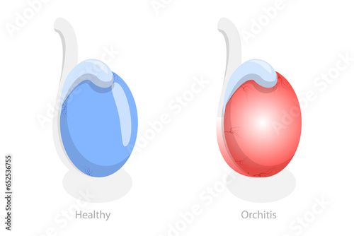 3D Isometric Flat  Conceptual Illustration of Orchitis, Inflammation of Testes photo